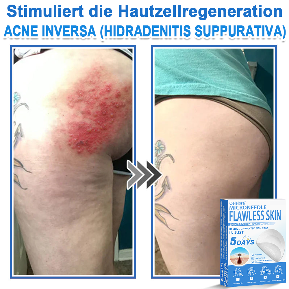 80%OFF 📌 Celsiora® 2-in-1 Mikronadel- & Hydrokolloid-Pflaster | Entferner für erhabene Muttermale, Akne, flache Warzen & Hautanhängsel | Verbessert Falten, Narben & Hautunreinheiten | Unsichtbare Stern-Pickelpflaster für Gesicht & Körper (Copy)