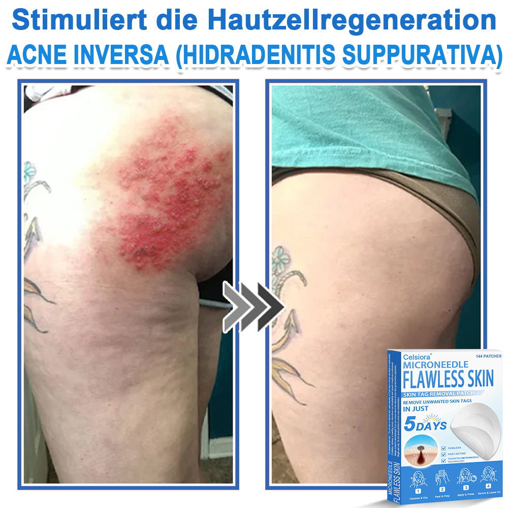 🌿Celsiora® 2-in-1 Mikronadel-Hydrokolloid-Pflaster | Gegen Hautanhängsel, Warzen, Muttermale & Akne | Glättet Falten, Narben & Hautunreinheiten | Unsichtbare Pflaster für Gesicht & Körper
