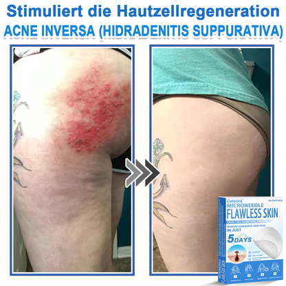 🌿Celsiora® 2-in-1 Mikronadel-Hydrokolloid-Pflaster | Gegen Hautanhängsel, Warzen, Muttermale & Akne | Glättet Falten, Narben & Hautunreinheiten | Unsichtbare Pflaster für Gesicht & Körper
