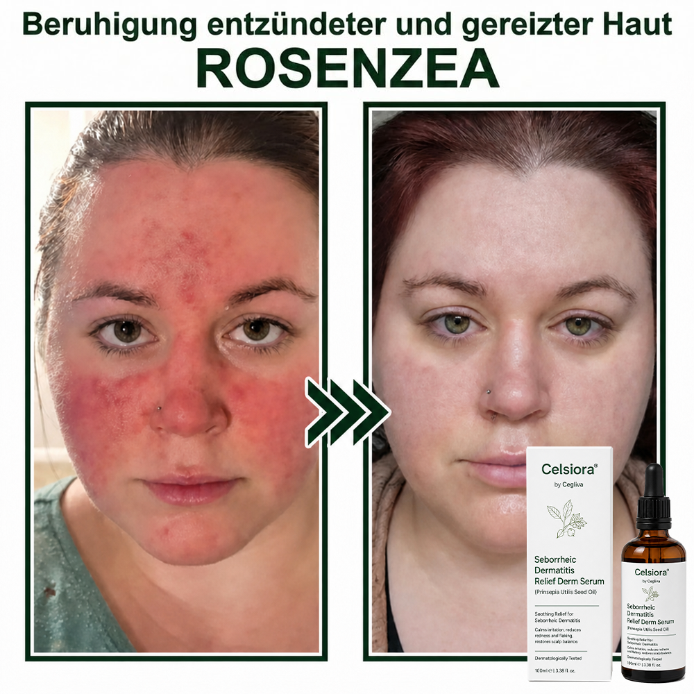 💚Celsiora® Beruhigendes Serum bei seborrhoischer Dermatitis
