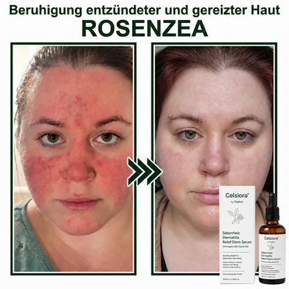 💚Celsiora® Beruhigendes Serum bei seborrhoischer Dermatitis