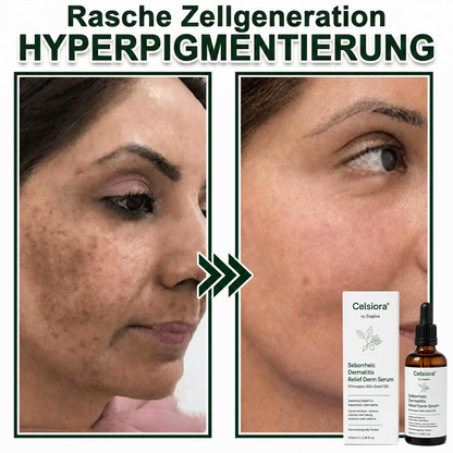 💚Celsiora® Beruhigendes Serum bei seborrhoischer Dermatitis