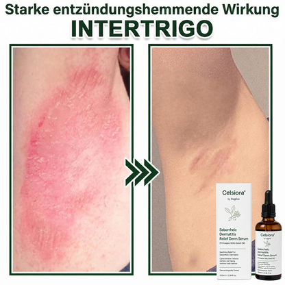 💚Celsiora® Beruhigendes Serum bei seborrhoischer Dermatitis