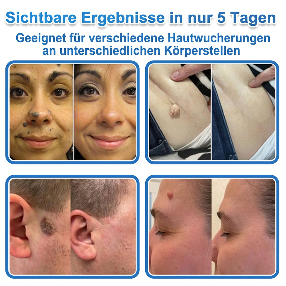 80%OFF 📌 Celsiora® 2-in-1 Mikronadel- & Hydrokolloid-Pflaster | Entferner für erhabene Muttermale, Akne, flache Warzen & Hautanhängsel | Verbessert Falten, Narben & Hautunreinheiten | Unsichtbare Stern-Pickelpflaster für Gesicht & Körper (Copy)