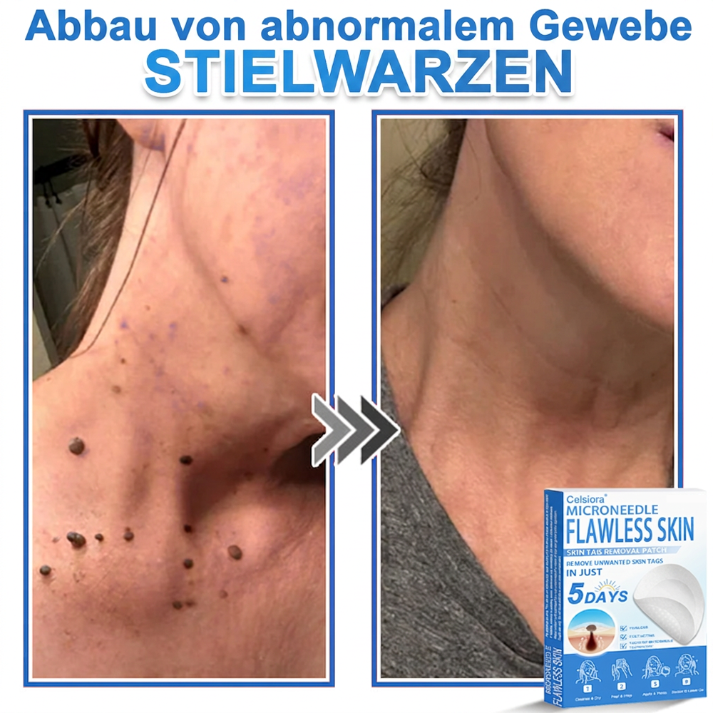 80%OFF 📌 Celsiora® 2-in-1 Mikronadel- & Hydrokolloid-Pflaster | Entferner für erhabene Muttermale, Akne, flache Warzen & Hautanhängsel | Verbessert Falten, Narben & Hautunreinheiten | Unsichtbare Stern-Pickelpflaster für Gesicht & Körper (Copy)