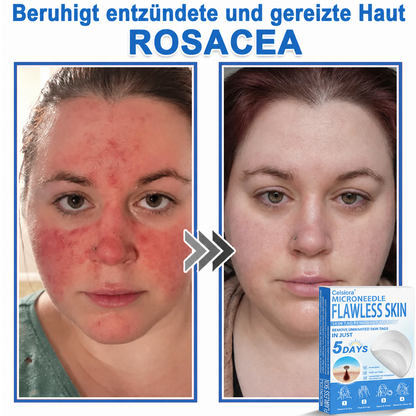 80%OFF 📌 Celsiora® 2-in-1 Mikronadel- & Hydrokolloid-Pflaster | Entferner für erhabene Muttermale, Akne, flache Warzen & Hautanhängsel | Verbessert Falten, Narben & Hautunreinheiten | Unsichtbare Stern-Pickelpflaster für Gesicht & Körper (Copy)