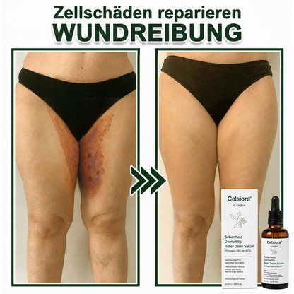 💚Celsiora® Beruhigendes Serum bei seborrhoischer Dermatitis