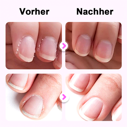 upsell🔥✨Kaufe 1 und erhalte 1 gratis 💜2025 Neuer und verbesserter 3-in-1-Nagelpflegestift.